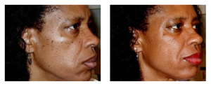 black skin fibromas removal