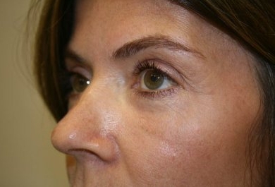 coolpeel laser before and after