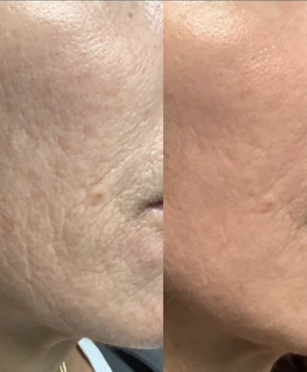 Tetra CO2 laser resurfacing before and after Charlotte NC
