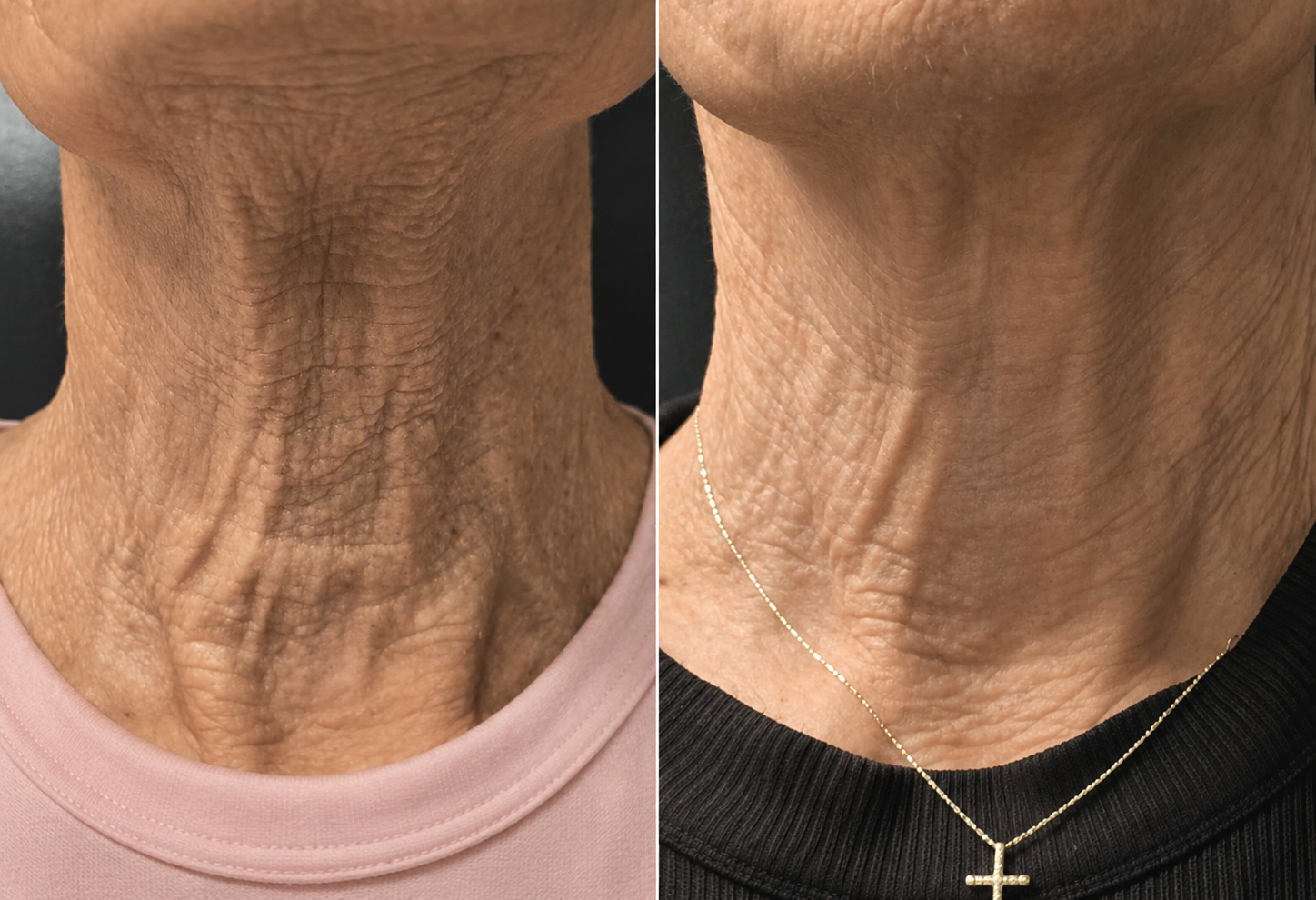 Tetra CO2 laser resurfacing Charlotte NC