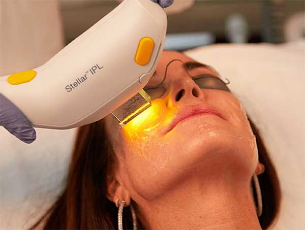 IPL BBL photofacial Charlotte NC