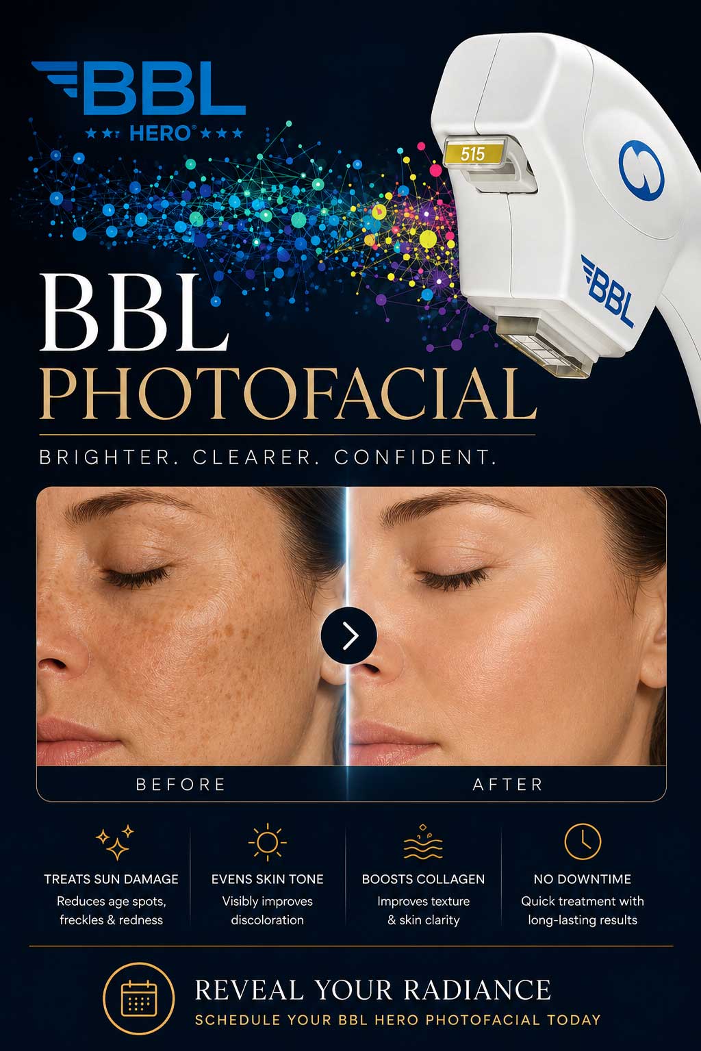 Sciton BBL JOULE photofacial Charlotte NC for sun spots redness pigmentation and broken capillaries