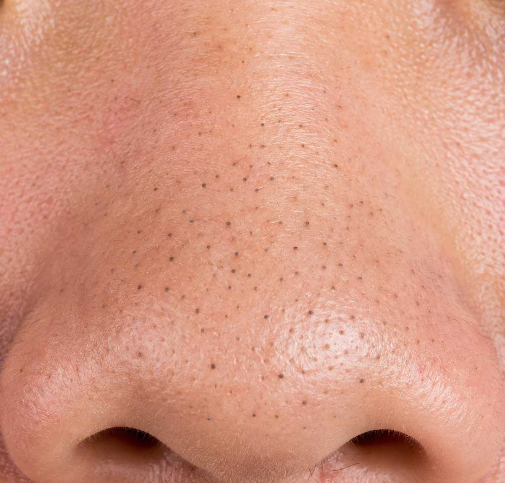 Close-up of blackheads and open comedones evaluated for professional blackhead removal in Charlotte NC near Ballantyne
