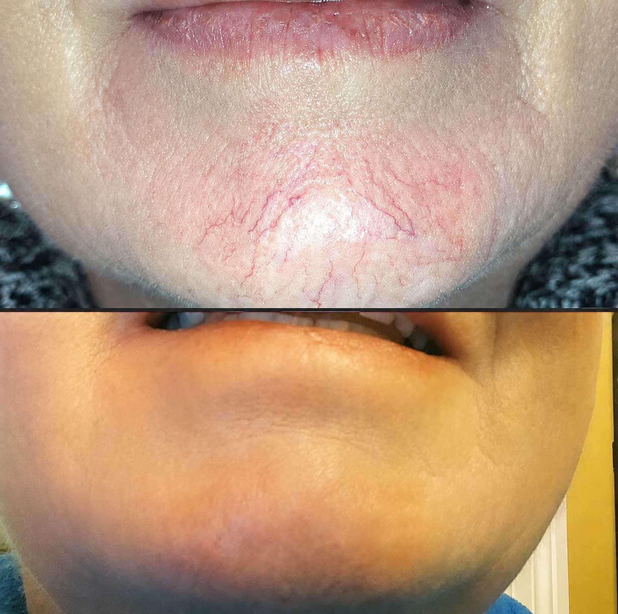 Tiny facial capillaries and broken vessels treated with ThermoClear in Charlotte NC