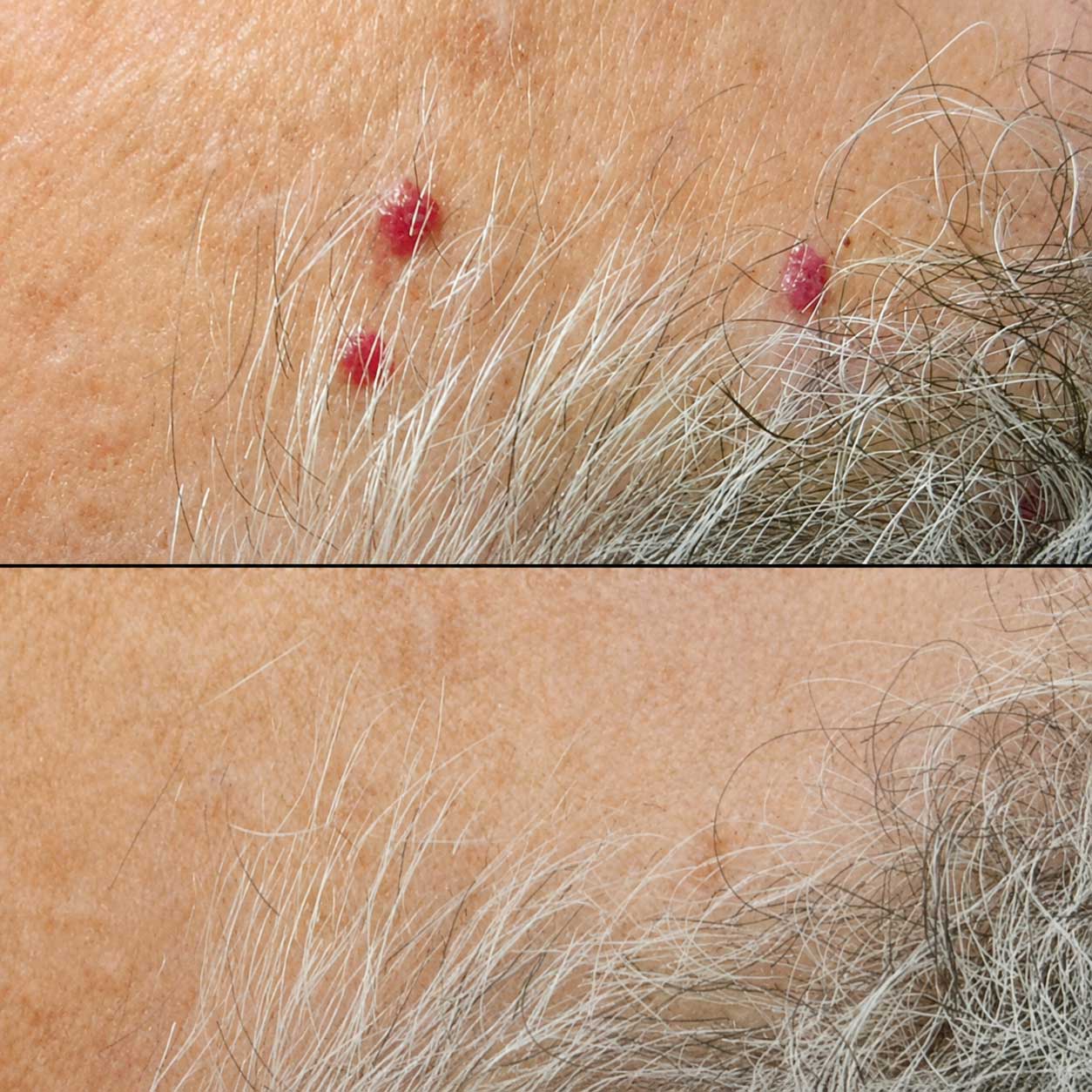 Cherry angioma before ThermoClear treatment in Charlotte NC