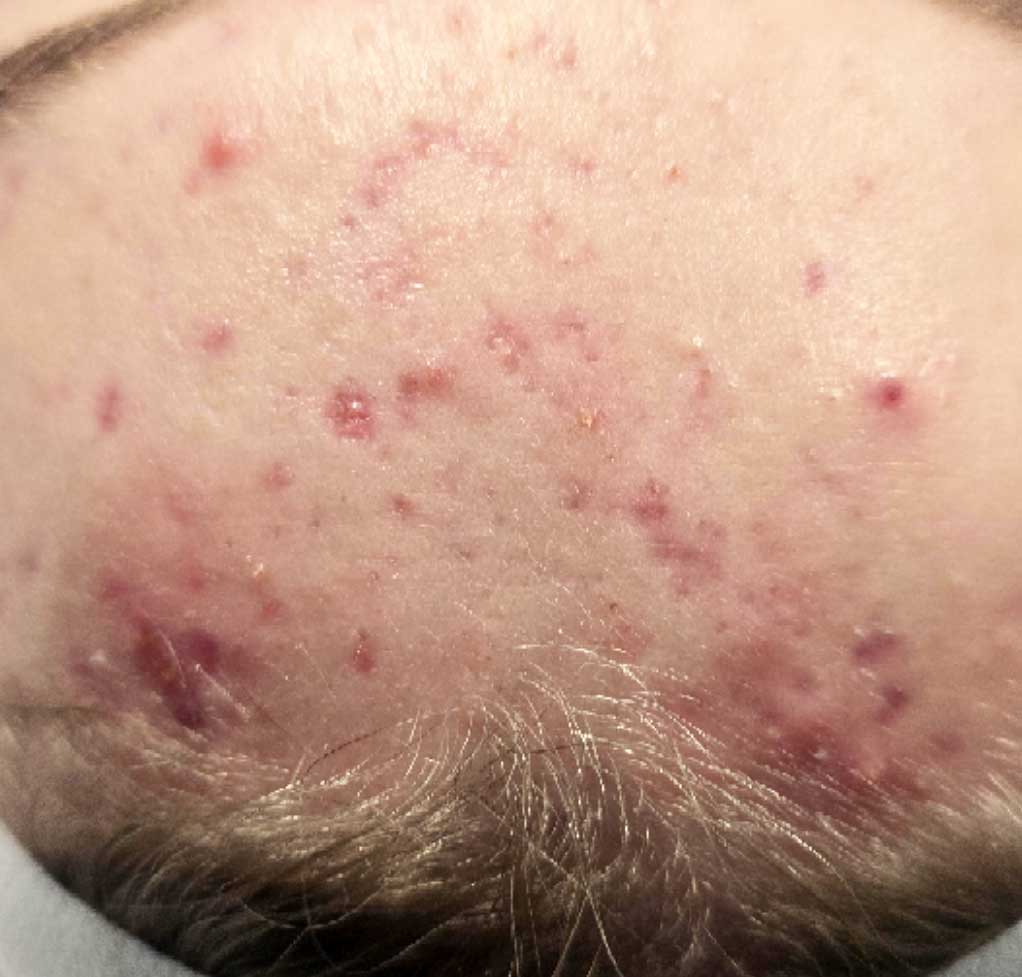 Professional extractions of congested facial pores. acne, pimples and pastules professional facial extractions in Charlotte NC