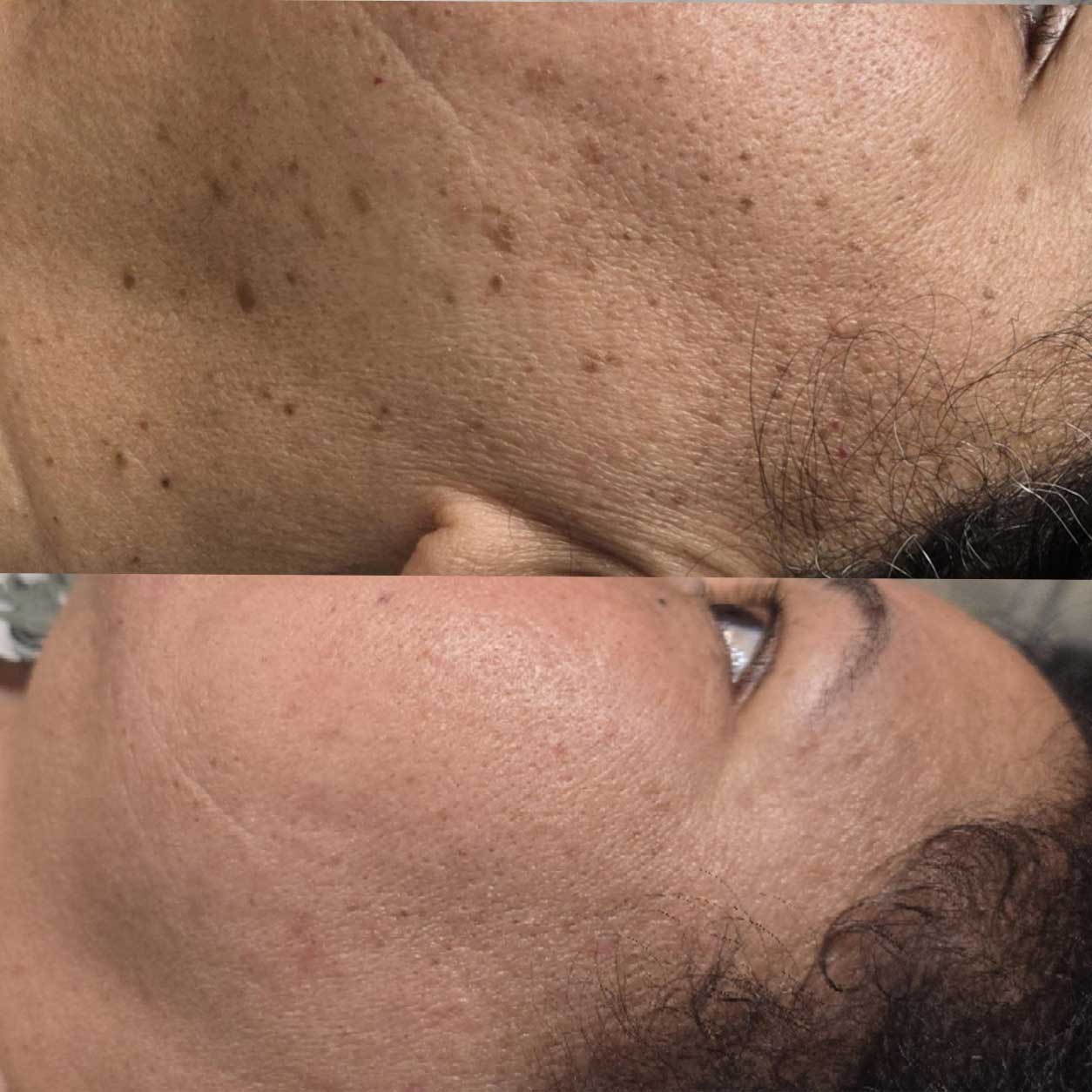 Dermatosis Papulosa Nigra DPN facial bumps before ThermoClear treatment in Charlotte 