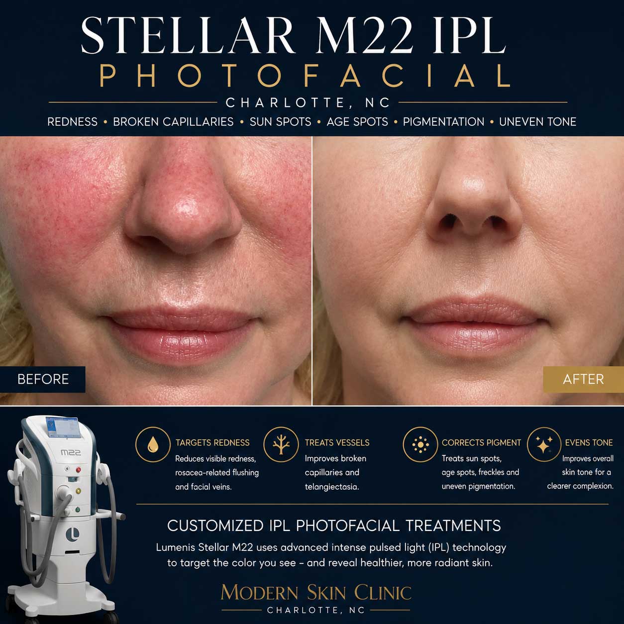 Lumenis Stellar M22 IPL photofacial Charlotte NC for redness broken capillaries sun spots and pigmentation