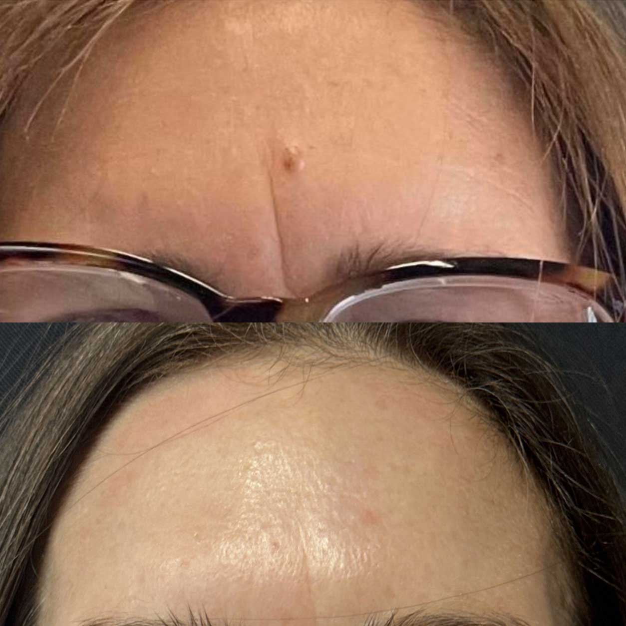 Selected benign superficial skin concerns evaluated for ThermoClear treatment in Charlotte NC
