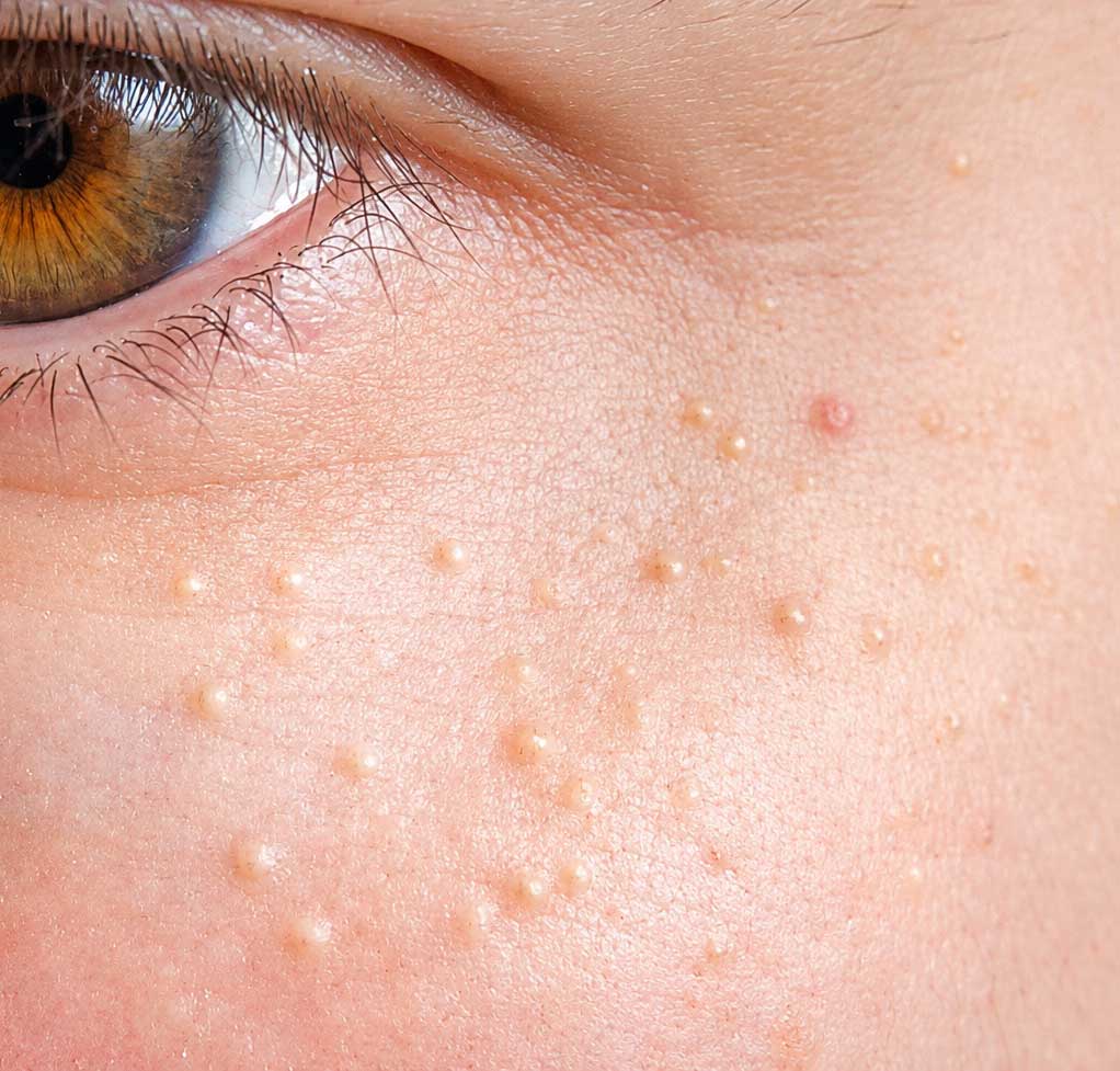 Close-up of under-eye milia evaluated for professional treatment at Modern Skin Clinic in Charlotte NC