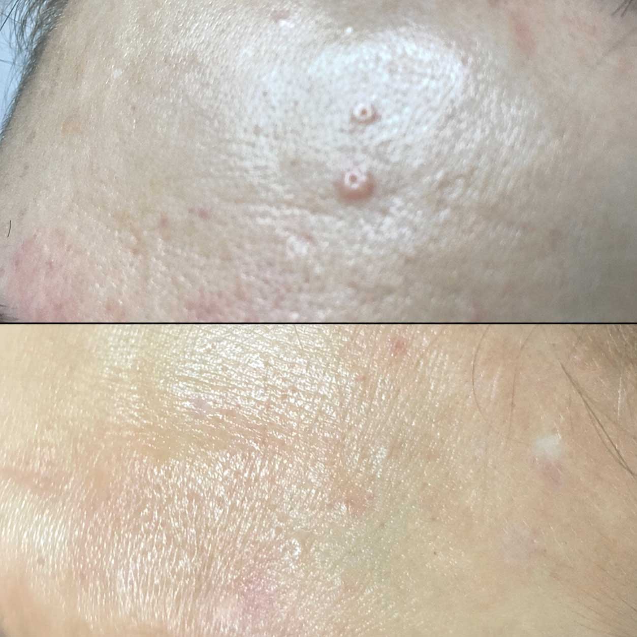 Sebaceous hyperplasia facial bumps treated with ThermoClear in Charlotte NC