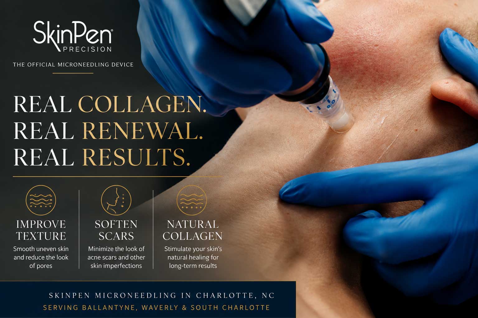 SkinPen microneedling treatment in Charlotte NC for acne scars skin texture and collagen renewal