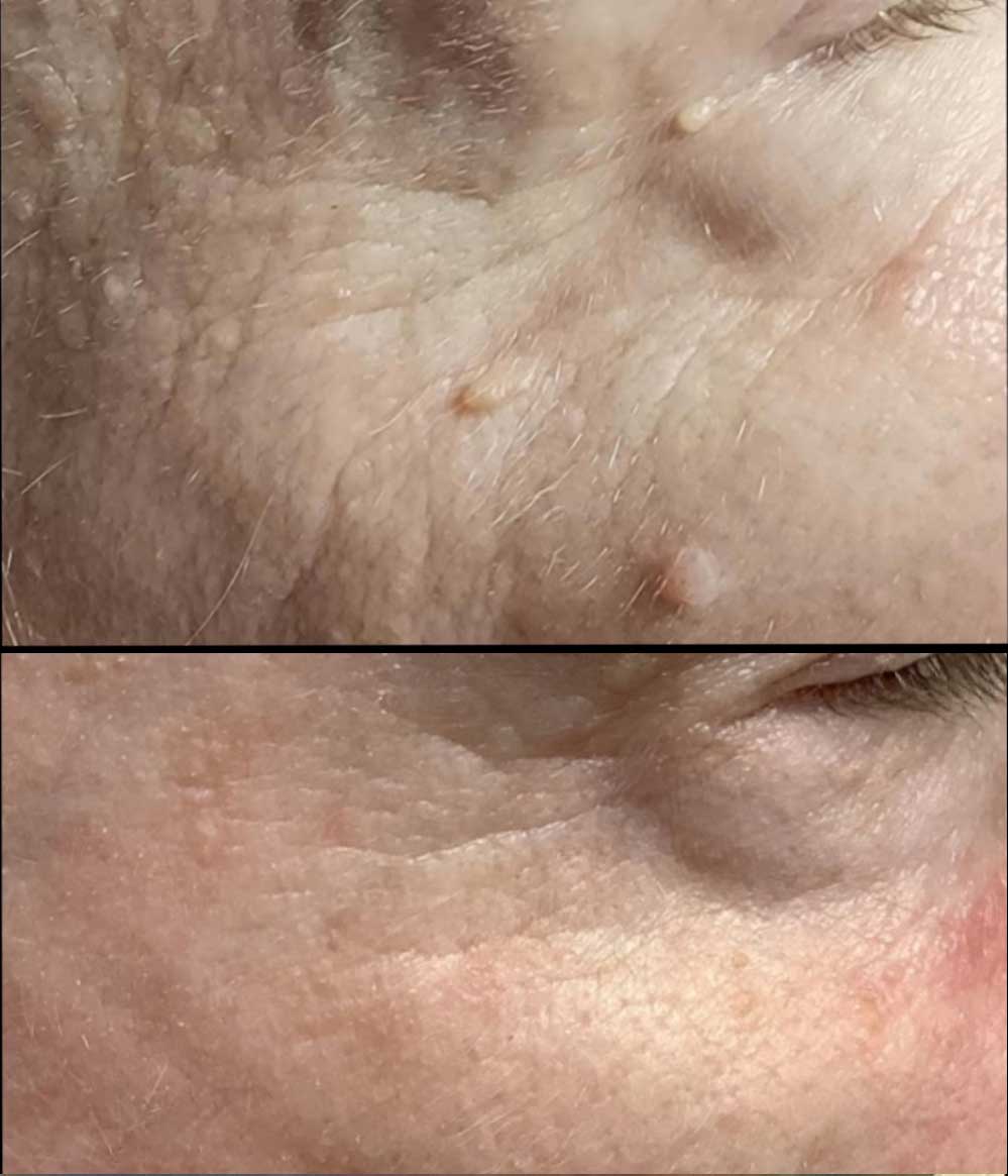Skin tags on neck before ThermoClear skin tag removal in Charlotte NC