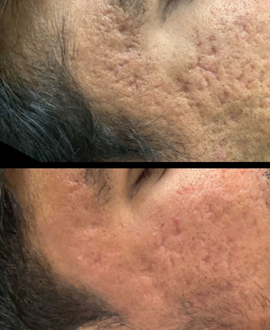 Virtue RF microneedling before and after for acne scar and skin texture improvement in Charlotte NC