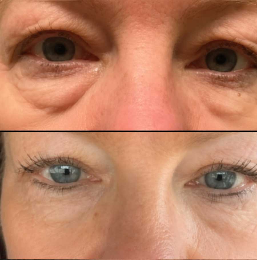 Virtue rf with exact rf for lower eye lids and eye bag removal in Charlotte, NC