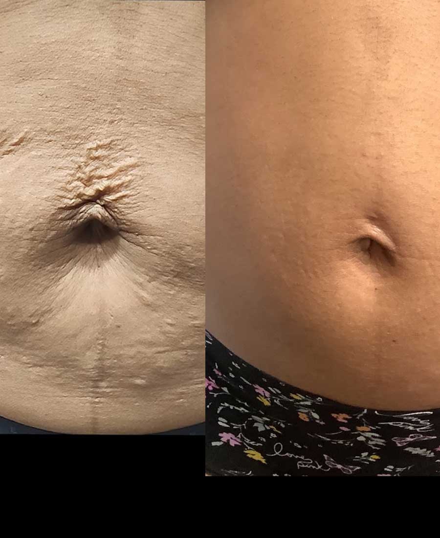 Virtue RF microneedling before and after for abdominal skin texture and firmness in Charlotte NC